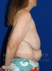 Breast Reduction Patient 97519 Before Photo # 1