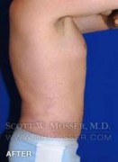 Liposuction - Abdomen & Flanks Patient 25141 After Photo Thumbnail # 8
