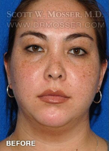 Chin Implant Patient 69285 Before Photo # 1