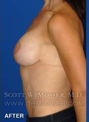 Breast Lift With Implants Patient 19074 After Photo # 10