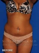 Liposuction - Abdomen & Flanks Patient 41506 Before Photo Thumbnail # 1