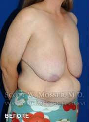 Breast Reduction Patient 97519 Before Photo # 5