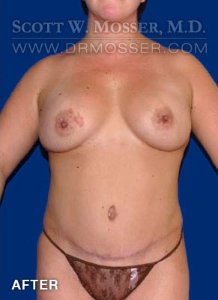 Abdominoplasty Patient 15755 After Photo # 2