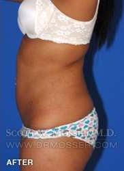 Liposuction - Abdomen & Flanks Patient 41506 After Photo # 10