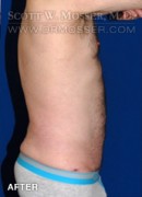 Liposuction - Abdomen & Flanks Patient 23232 After Photo Thumbnail # 6