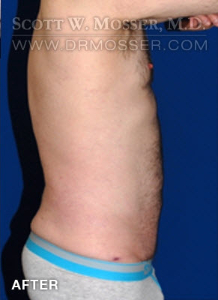 Liposuction - Abdomen & Flanks Patient 23232 After Photo # 6