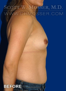 Breast Augmentation Patient 47902 Before Photo # 5