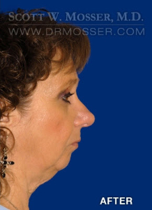Rhinoplasty Patient 80799 After Photo # 2