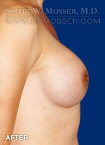 Breast Augmentation Patient 47960 After Photo # 4