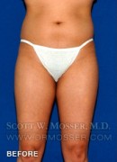 Liposuction - Thighs Patient 46631 Before Photo Thumbnail # 1