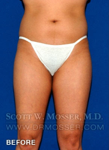Liposuction - Thighs Patient 46631 Before Photo # 1