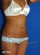 Liposuction - Abdomen & Flanks Patient 41506 After Photo Thumbnail # 4