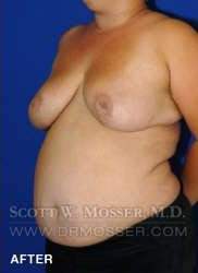 Breast Reduction Patient 24410 After Photo # 6