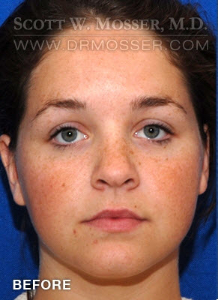 Liposuction - Face Patient 40198 Before Photo # 1