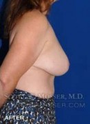 Breast Reduction Patient 97519 After Photo Thumbnail # 2