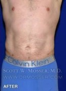 Liposuction - Abdomen & Flanks Patient 64992 After Photo Thumbnail # 2
