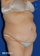 Abdominoplasty Patient 72192 Before Photo Thumbnail # 5