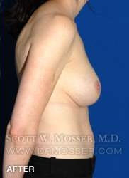Breast Asymmetry Correction Patient 37996 After Photo # 6