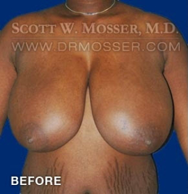 Breast Reduction Patient 70589 Before Photo # 1
