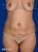 Abdominoplasty Patient 81038 Before Photo Thumbnail # 1