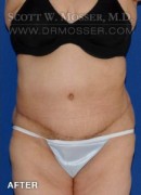 Abdominoplasty Patient 72192 After Photo Thumbnail # 2