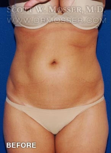 Liposuction - Abdomen & Flanks Patient 39576 Before Photo # 1