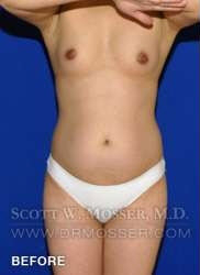 Liposuction - Thighs Patient 89876 Before Photo # 3