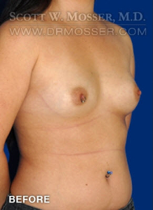 Breast Augmentation Patient 59926 Before Photo # 3