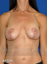 Breast Lift With Implants Patient 19074 After Photo # 2