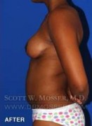 Breast Lift Without Implants Patient 55667 After Photo Thumbnail # 10