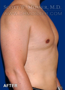 Liposuction - Chest Patient 10587 After Photo # 4