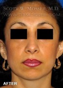 Rhinoplasty Patient 13734 After Photo Thumbnail # 2
