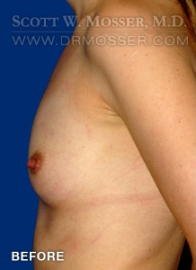 Breast Augmentation Patient 51986 Before Photo # 5