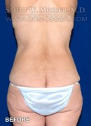 Lower Body Lift Patient 68424 Before Photo Thumbnail # 7