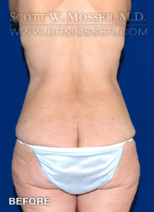 Lower Body Lift Patient 68424 Before Photo # 7