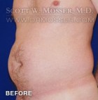 Liposuction - Abdomen & Flanks Patient 62116 Before Photo Thumbnail # 5
