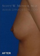 Nipple Inversion Correction Patient 38571 After Photo Thumbnail # 6