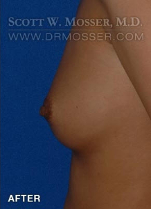 Nipple Inversion Correction Patient 38571 After Photo # 6