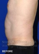 Liposuction - Abdomen & Flanks Patient 64992 Before Photo Thumbnail # 9
