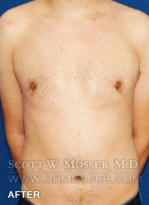 Liposuction - Chest Patient 34240 After Photo # 2