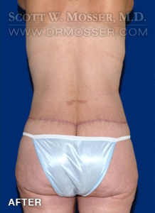 Lower Body Lift Patient 68424 After Photo # 8