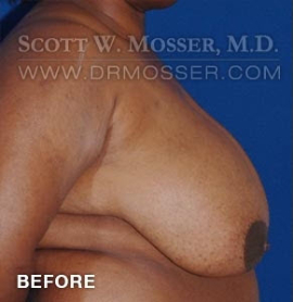 Breast Reduction Patient 91361 Before Photo # 5