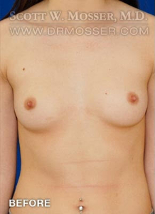 Breast Augmentation Patient 84593 Before Photo # 1