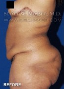 Lower Body Lift Patient 16603 Before Photo Thumbnail # 5