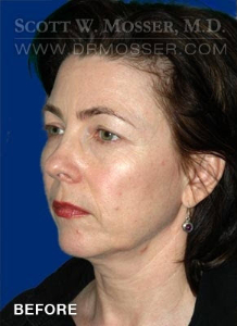Chin Implant Patient 16572 Before Photo # 3