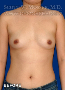 Breast Augmentation Patient 21794 Before Photo # 3