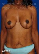 Breast Lift With Implants Patient