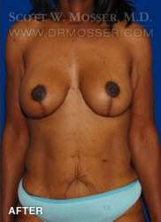 Breast Lift With Implants Patient 11670 After Photo # 2
