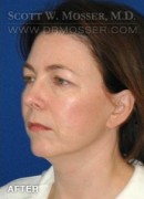 Chin Implant Patient 16572 After Photo Thumbnail # 4