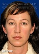 Upper Blepharoplasty Patient 81608 Before Photo Thumbnail # 1